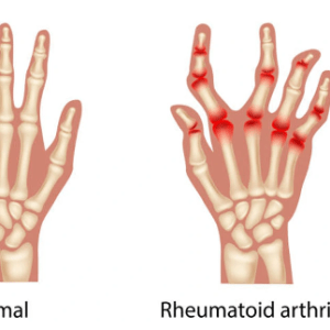 artritis