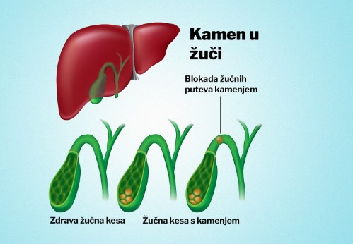 zucne kamence